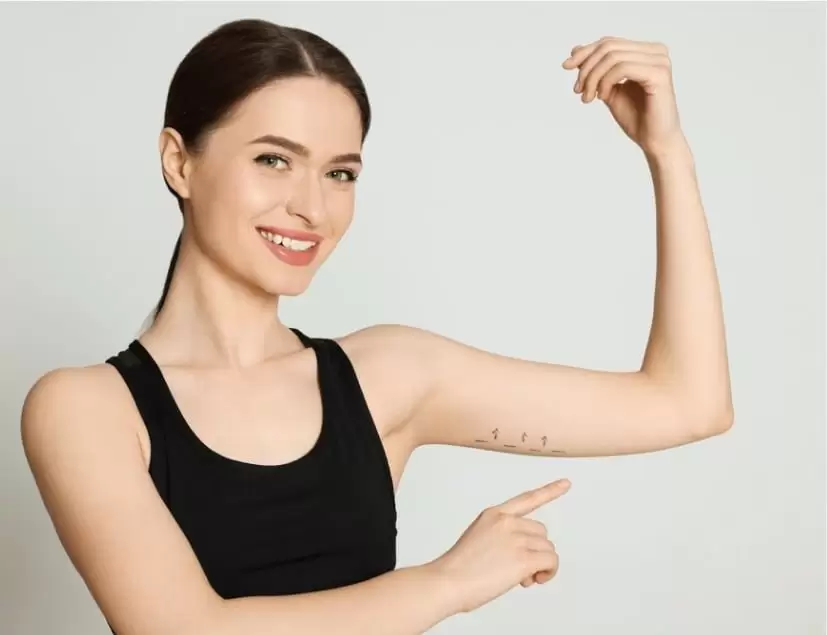 Arm Liposuction Recovery2