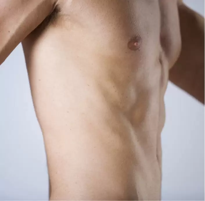 Candidate For Male Breast Reduction Surgery 