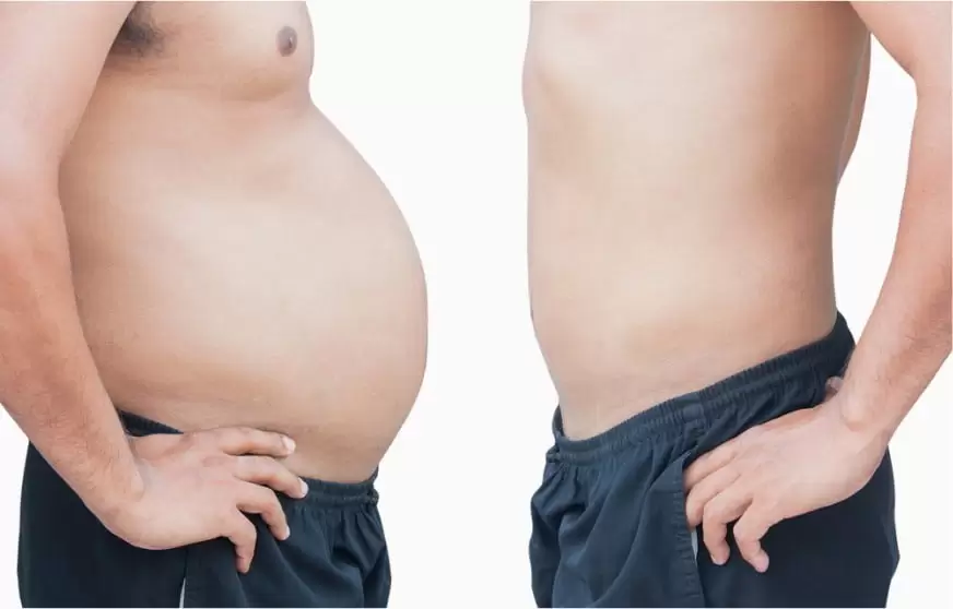 Male tummy tuck before and after the procedure