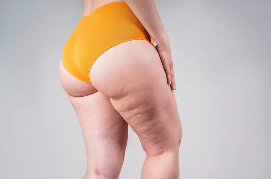 Lipoedema liposuction after care with compression garments
