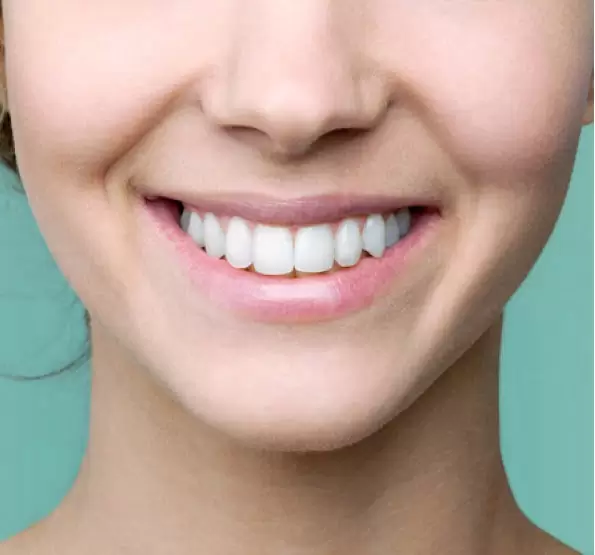 Different Types of Professional Teeth Whitening-2