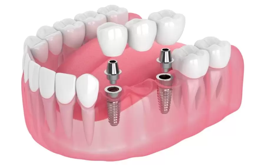 What To Know About Dental Implants