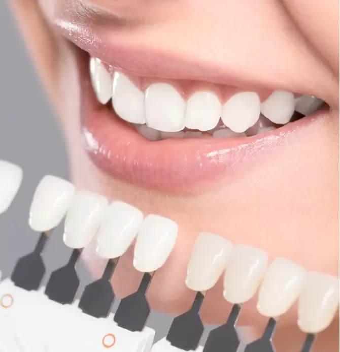 What Types of Dental Veneers Are There