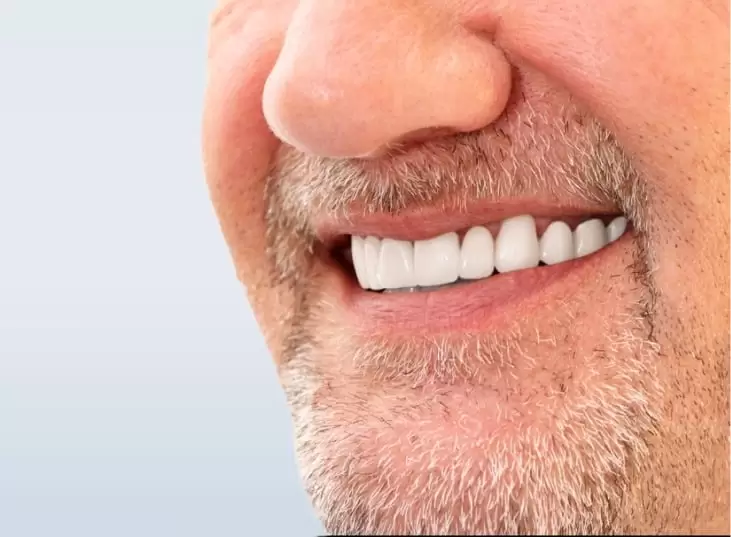 Who Is The Best Candidate for Dental Veneers