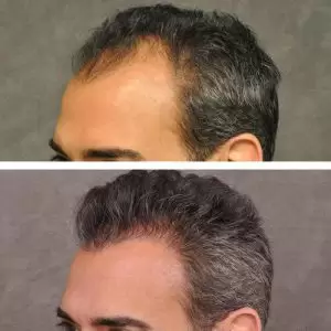 Dr. Abdullah Etoz ‌Before and Afters
