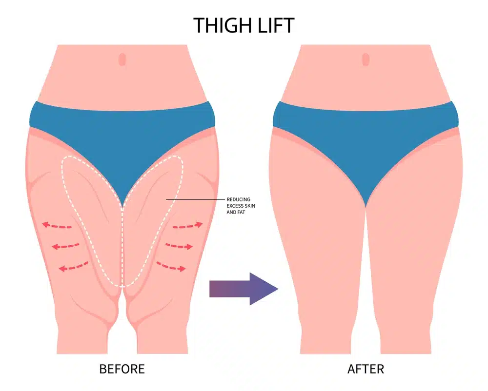 Common Questions on Thigh Lipo