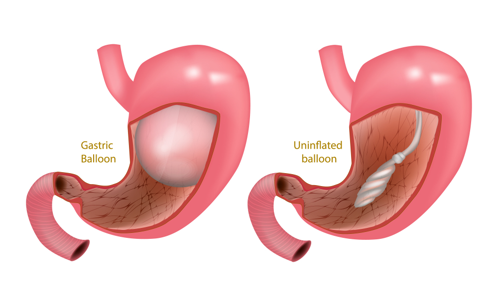Gastric Balloon 101: Best Candidates, Tips & Facts