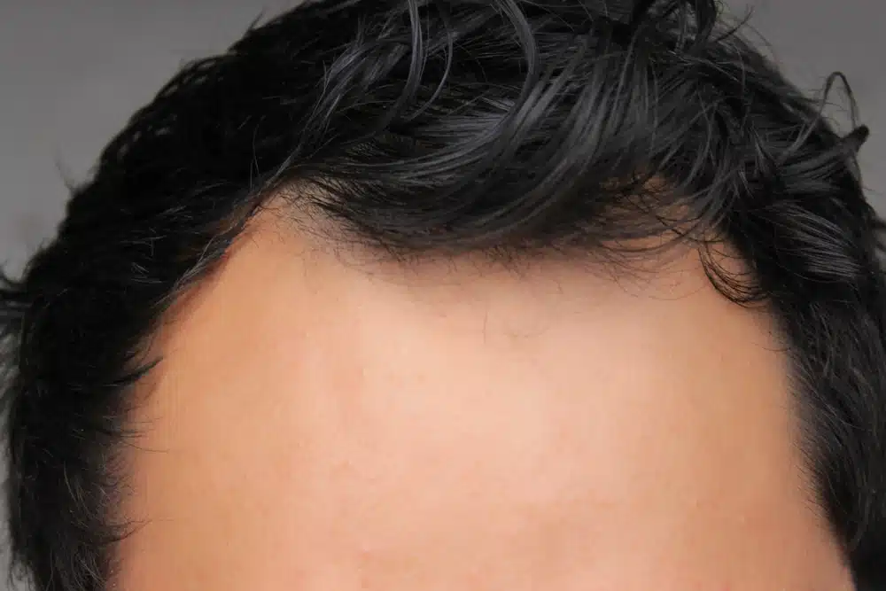 Temporal Hairline
