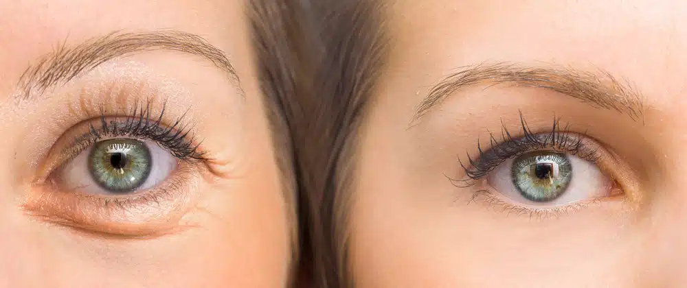 What You Need to Know About Eyelid Surgery