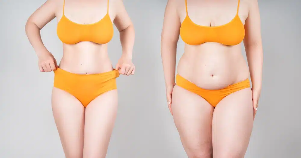 Challenges in Belly Liposuction