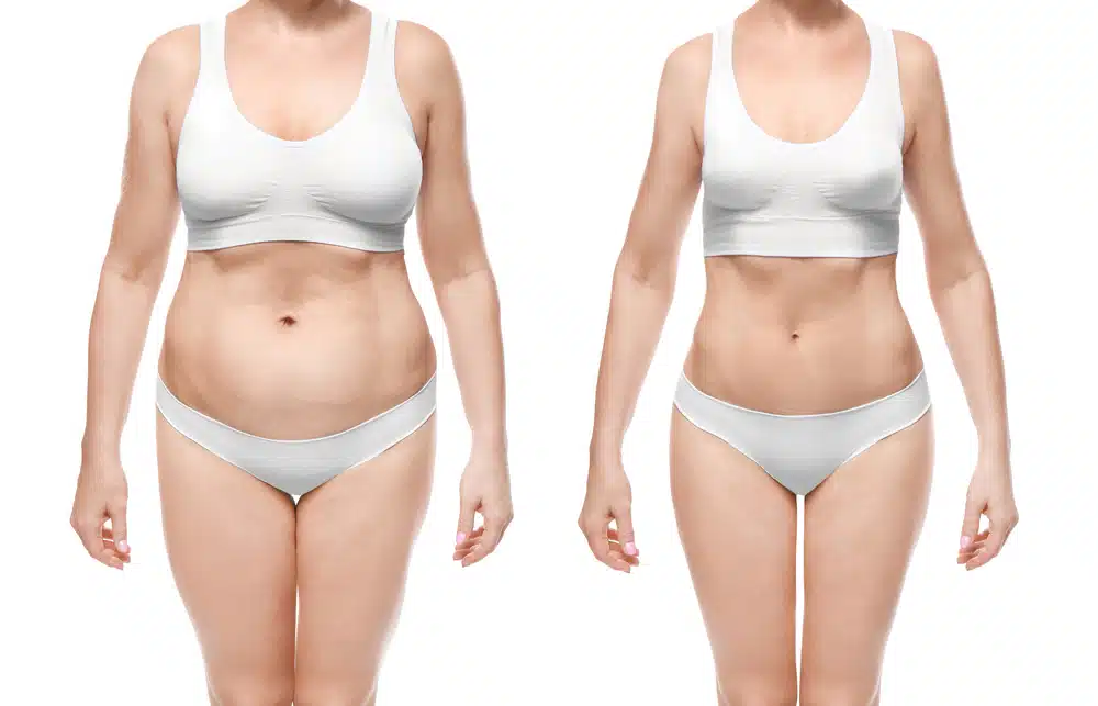What Areas Get Lipoed in a Belly Liposuction