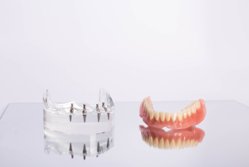 History of Dental Implants