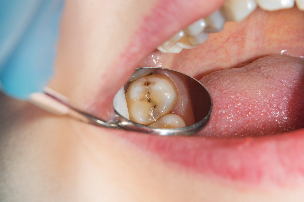 tooth decay despite having implants