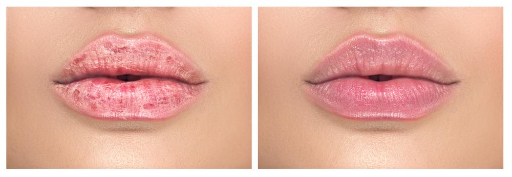 Can your lips become chapped with filler