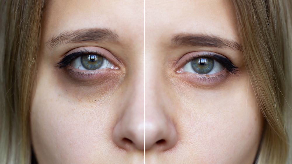 Causes of Dark Circles Under the Eyes