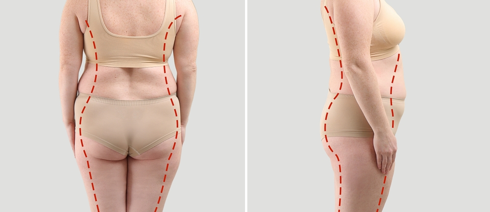 In which areas do patients see improvement with body shaping or liposculpture surgeries