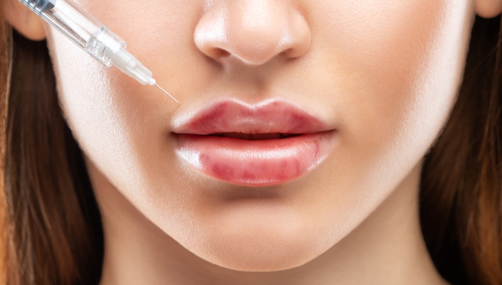 Swelling & Bruising Are Common After Lip Injections