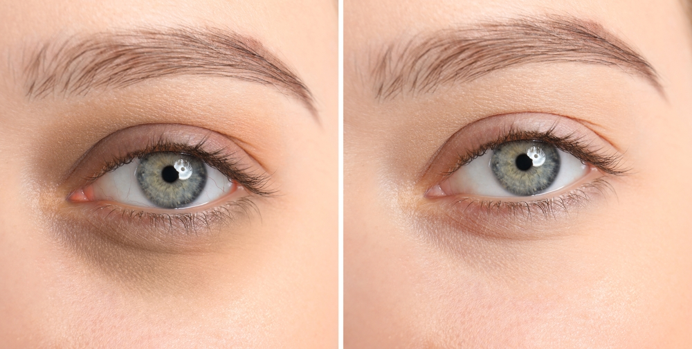 Three Types of Dark Under-Eyes Circles